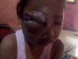 Assyfa Gadis Kecil Penderita Kanker Kelopak Mata Yang Membutuhkan Uluran Tangan