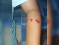 Viral Bocah di Kuansing Selamat dari Gigitan Buaya saat Mandi Sungai